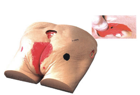 壓瘡(褥瘡)護理模型