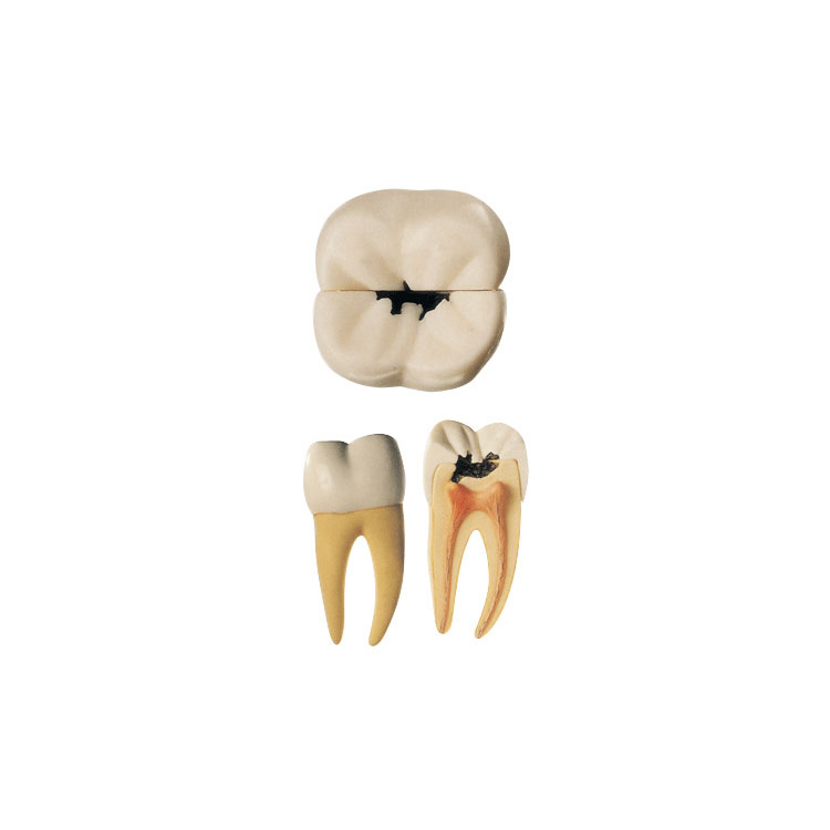 牙齒病變模型